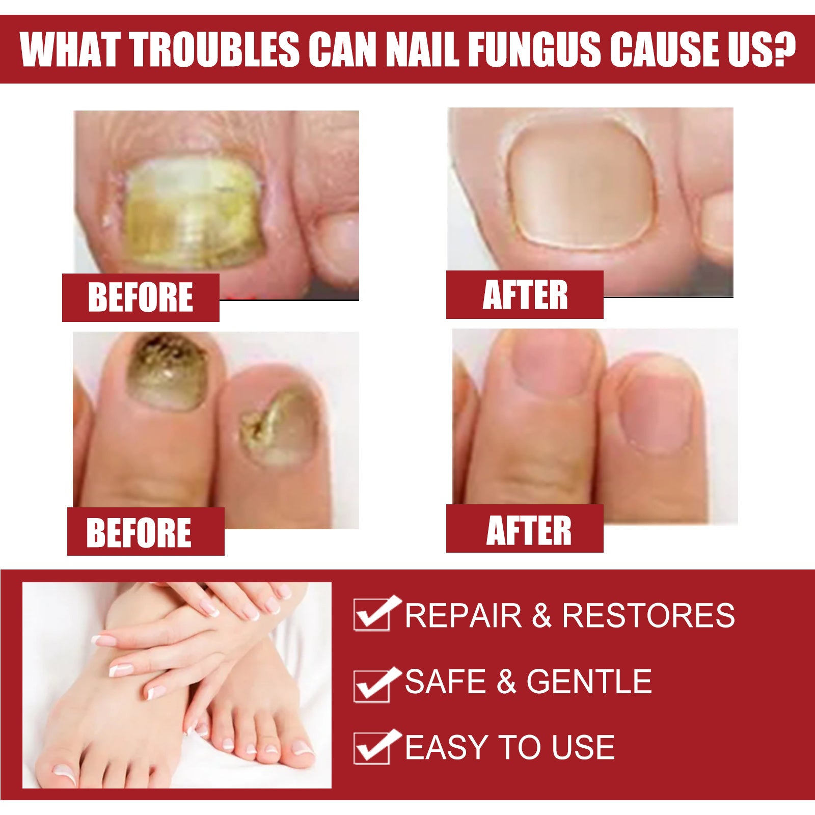 EELHOE Nail Repair Solution, Hands And Feet Nail Repair Moisturizing Clean And Remove Gray Nail Repair Solution eprolo